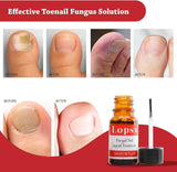 Fungal Nail Treatment