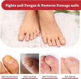 Fungal Nail Treatment