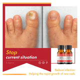 Fungal Nail Treatment for Toenails Extra Strong Lopsx Nail Fungus Treatment Toe Nail Fungal Treatment for Thick, Discolored Nails 10ml
