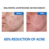 Tested by dermatologists, it is proved that acne is reduced by 60% after 6 weeks of use
