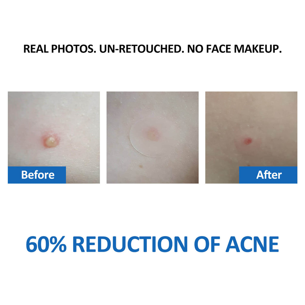 Acne Pimple Patch (108 count)